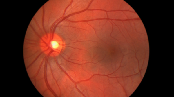 7 Lifestyle Modifications to Prevent Diabetic Retinopathy and Preserve Vision