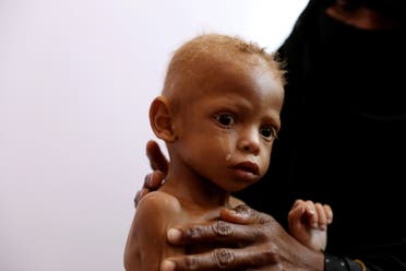 طفل يمني يعاني من سوء التغذية يتلقى علاجاً في مركز طبي بصنعاء (أرشيفية)