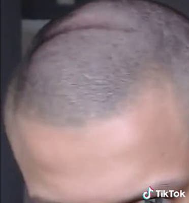 مشهد مرعب.. شاهد ماذا حل بجمجمة شاب بسبب سماعات الرأس مشهد مرعب.. شاهد ماذا حل بجمجمة شاب بسبب سماعات الرأس