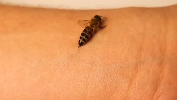 Bee Stings Watch Terrifying Video Closely What Happens When A Bee Stings You Karavalitimes