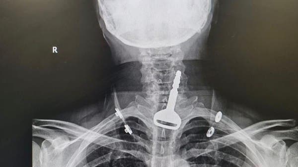 Successful Key Extraction Saves Patient’s Life in Al-Qunfudhah, Saudi Arabia