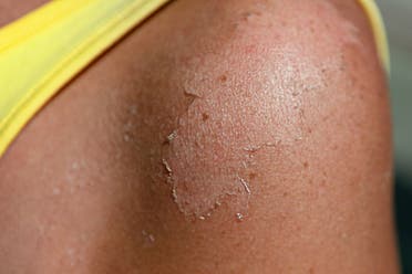تقشير الجلد بعد التعرض لآشعة الشمس - تعبيرية من آيستوك