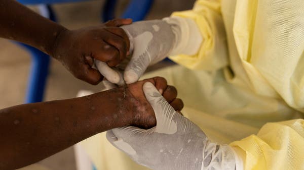 Mpox Is A Global Health Emergency Again; Should You Be Worried?